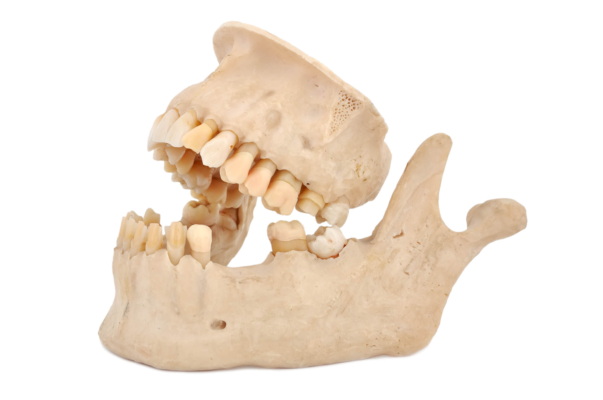 What Are Osteo Cavitations?