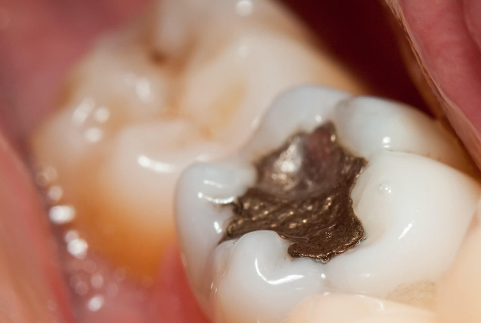 14 Facts About Mercury Toxicity From Amalgam Dental Fillings Pearl
