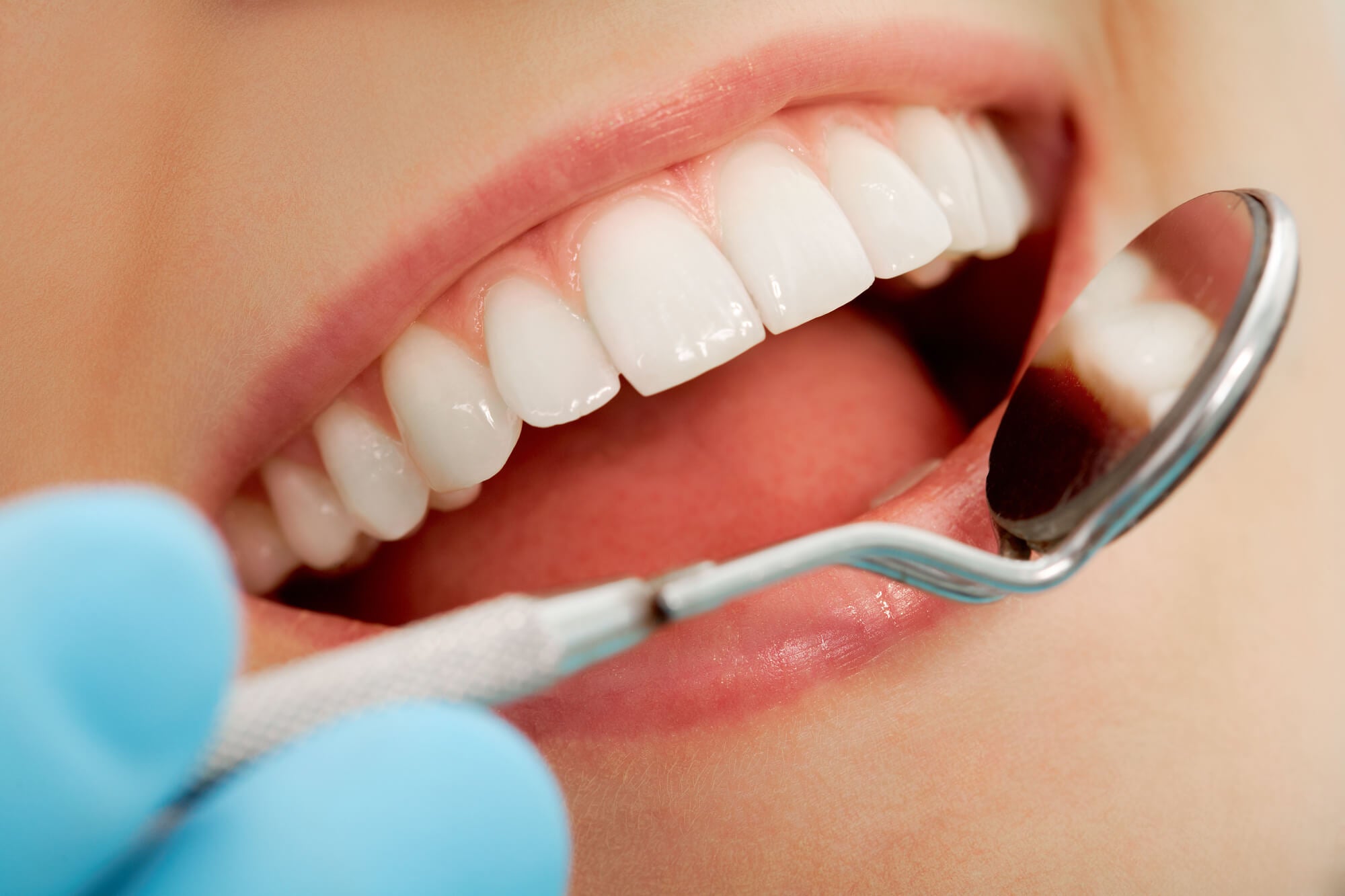 What Really Causes Tooth Decay?